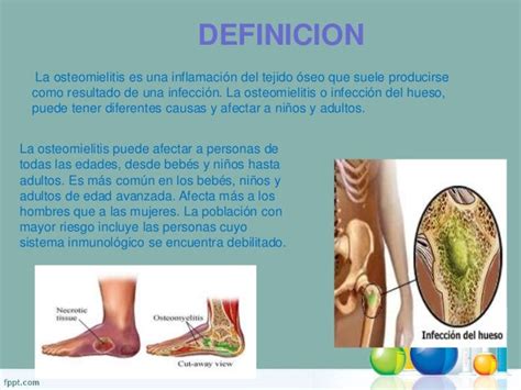 Osteoporosis Y Osteomielitis