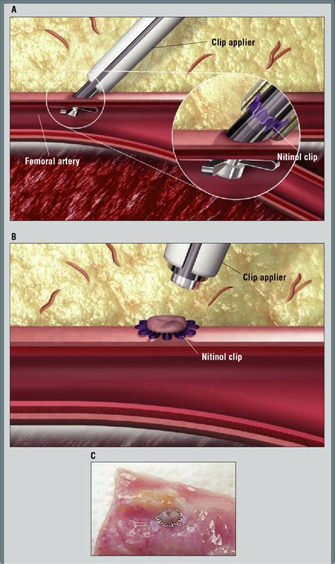 Femoral Artery Closure Devices