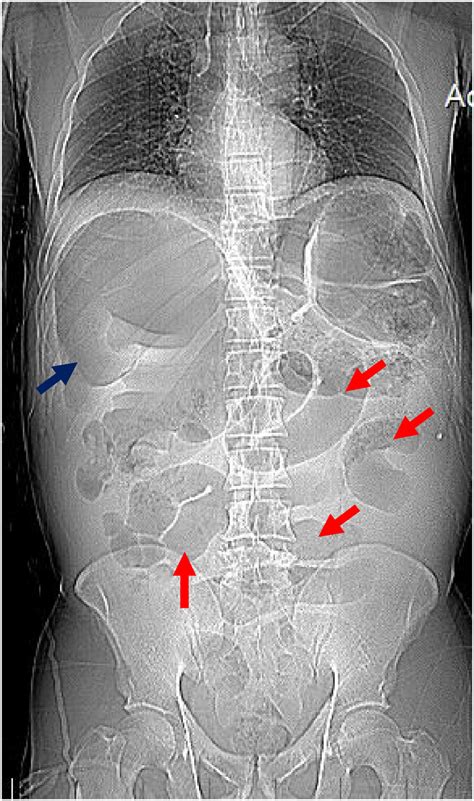 Plain Abdominal X Ray In Supine Position Red Arrows Multiple Dilated