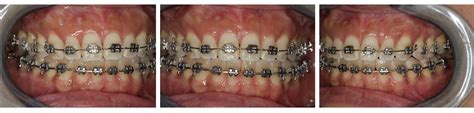 Orthodontic Retrognathic Maxillary Orthopedic Correction Of Anterior