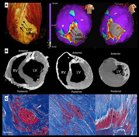 Delineation Of Scar Via Mri Electroanatomic Mapping And Histology