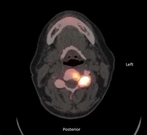 Axial Fused Fnaf Pet Ct Bone Scan Showing Degenerative Change In