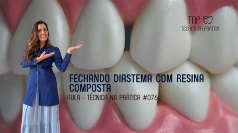 Fechamento De Diastema Com Resina Composta Tnp 076 Youtube