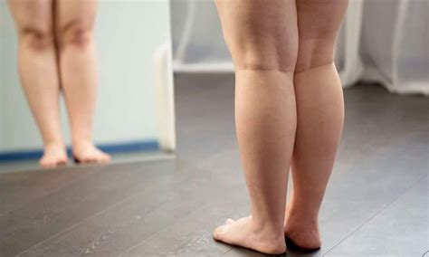 Sinais Do Lipedema Conheça Os 5 Principais Boa Forma