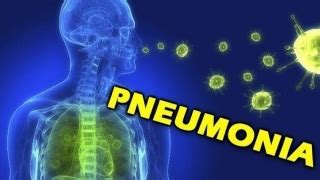 Pneumonia Quais As Causas Tratamento E Sintomas De Pneumonia