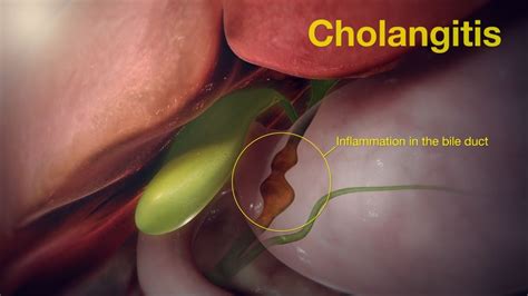 Kolangitis Penyebab Gejala Jenis Dan Pengobatan