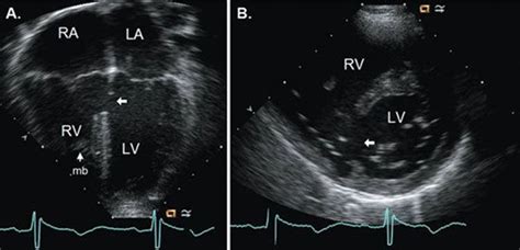 Ventricular Septal Defect Echo