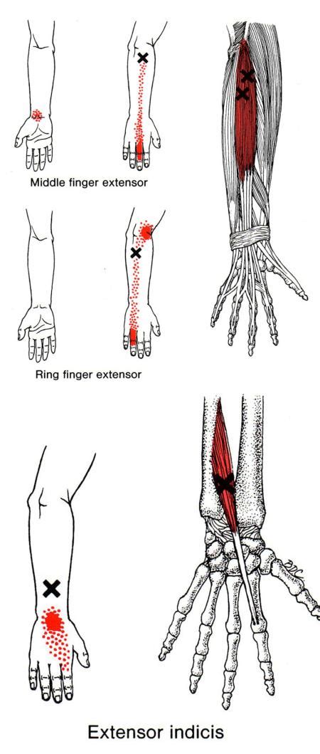 Extensor Digitorum The Trigger Point And Referred Pain Guide