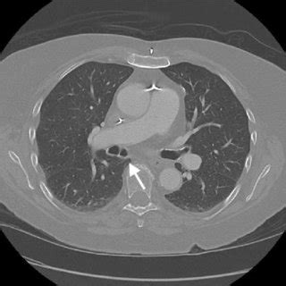 CT scan axial view at the level of right pulmonary artery: arrow ...