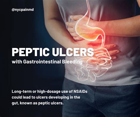 NSAIDS & Peptic Ulcers | Pain Management Specialist, Arthritis & Regenerative Medicine located ...