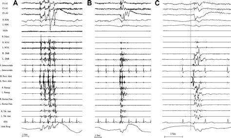 Fragmentary Hypnic Myoclonus And Other Isolated Motor Phenomena Of