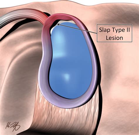 Imaging The Glenoid Labrum And Labral Tears Radiographics