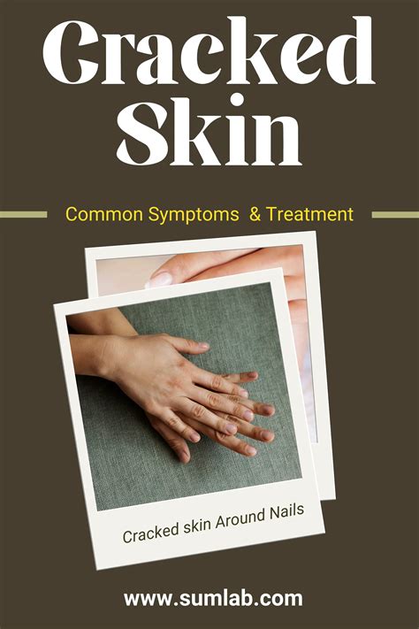 How to treat and prevent cracked skin around nails? | PDF