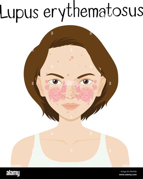 A Vector Of Lupus Erythematosus Illustration Stock Vector Image Art