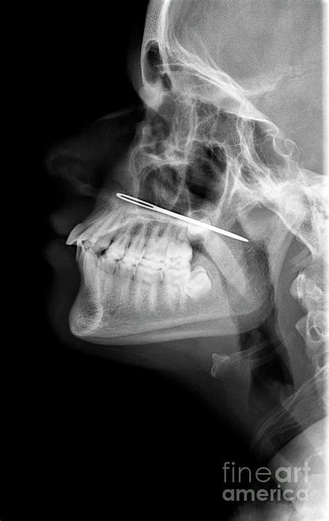 needle nose injury photograph  science photo library pixels