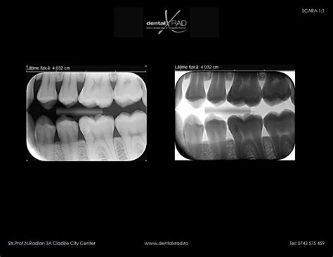 Tipuri De Radiografii Dentare