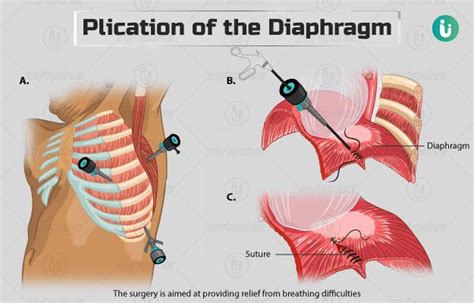 Plication of the Diaphragm: Procedure, Purpose, Results, Cost, Price