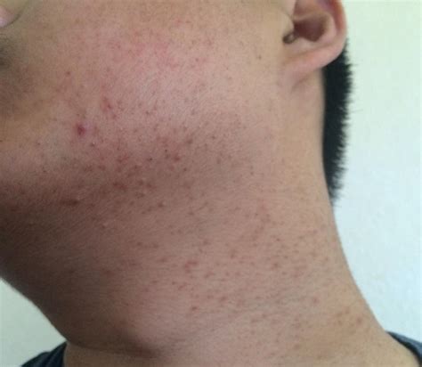 Malassezia Folliculitis Treatment