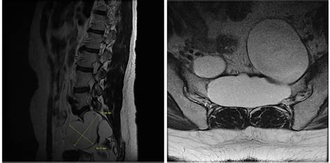 A Sagittal T2 Weighted Image Shows A 71 × 56 Cm Cyst That