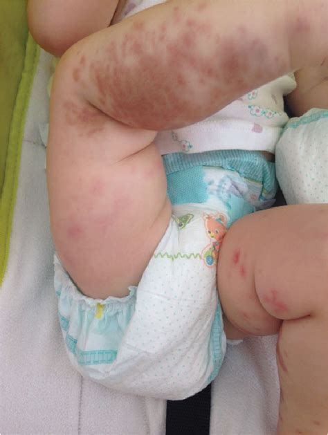 Figure 1 From An Infant With Purpuric Rash And Edema Semantic Scholar