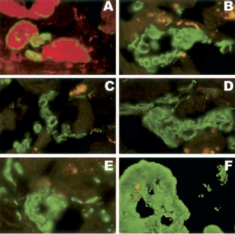 Figure From Transendocardial Autologous Bone Marrow Mononuclear Cell