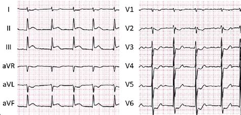 Twelve Lead Electrocardiography On Admission Showed Atrial Fibrillation