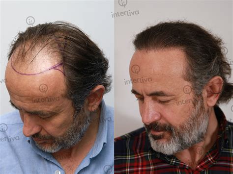 Fat Hair Transplant Interliva