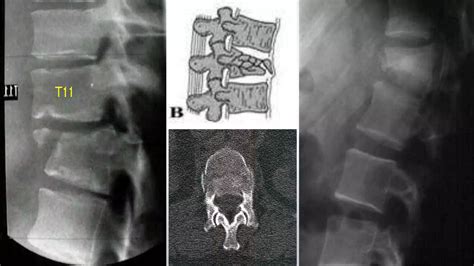 Thoracolumbar Fractures Classification Ppt