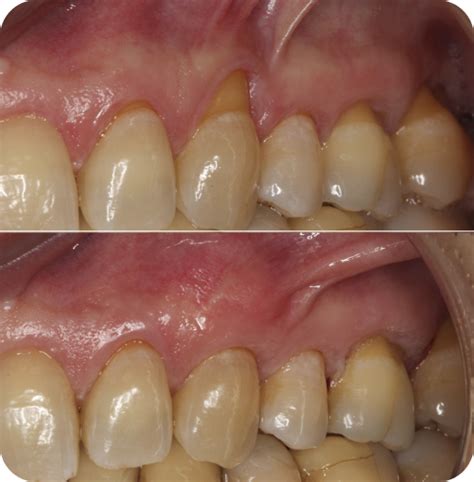 Gum Recession Grafting Periodontist New York City