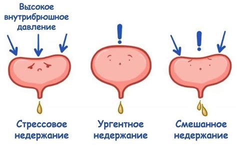 Лечение недержания мочи у женщин