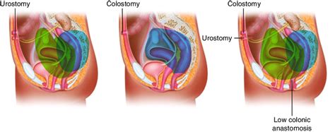 1 Types Of Pelvic Exenteration A Anterior B Posterior C Total