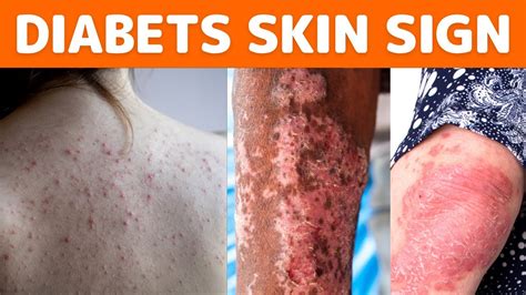 Unusual Skin Changes Signal Of Diabetes Skin Diabetes Symptoms