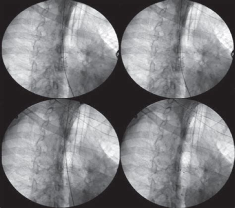 Fluoroscopia dilatación mecánica e inserción de prótesis esofágica