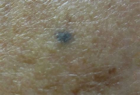 Mole Or Melanoma Test Yourself With These Suspicious Lesions