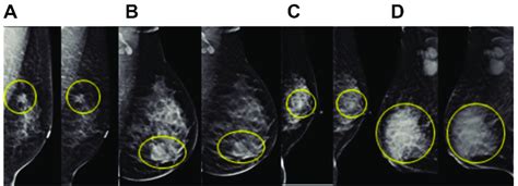 Tumors In Different Molecular Subtypes Of Breast Cancer The Yellow