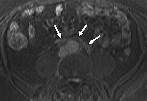 Retroperitoneal Fibrosis A Review Of Clinical Features And Imaging