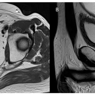 T2-W MRI assessment in post-treatment rectal cancer in the axial (A)... | Download Scientific ...