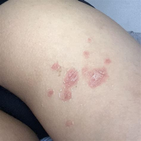 Fungal Infection or Eczema On Back Upper Thigh Area? : r/Dermatology