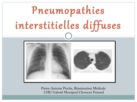 Pneumopathies Interstitielles Diffuses PDF ETUDE AZ