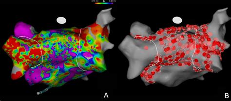 Electroanatomical Mapping Of The Left Atrium In Posteroanterior View In