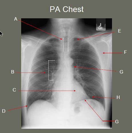 Pa Chest Mayo Radiograph Diagram Quizlet