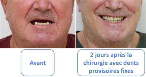 Charge immédiate sur implant dentaire Des dents provisoires directement