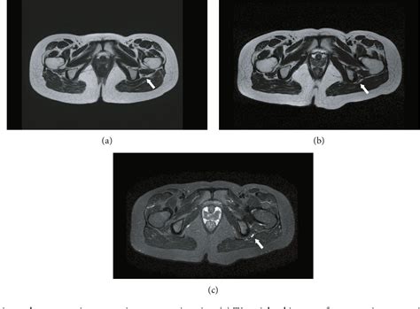 Figure From Sciatic Nerve Palsy Following Curved Periacetabular