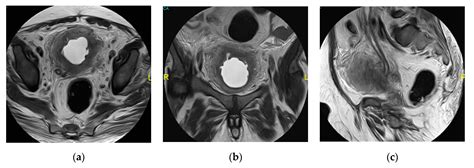 Medicina Free Full Text Ct And Mri In Urinary Tract Infections A