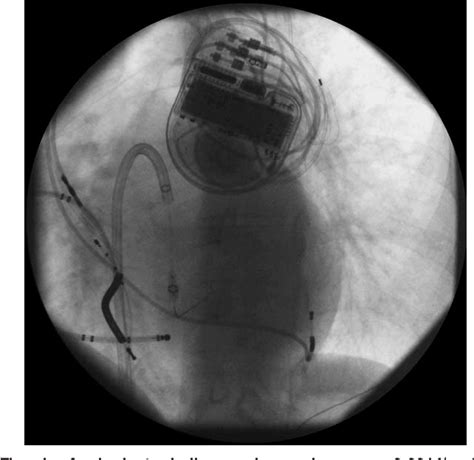 Figure 1 From VALVULAR AND STRUCTURAL HEART DISEASES Case Reports