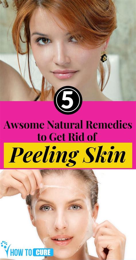 5 Awsome Natural Remedies To Get Rid Of Peeling Skin Howtocure Peeling Skin Skin Peeling On