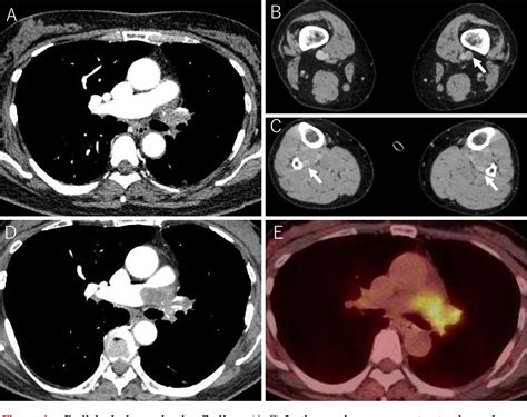 Figure 1 From Pulmonary Artery Sarcoma Diagnosed Using An Endovascular