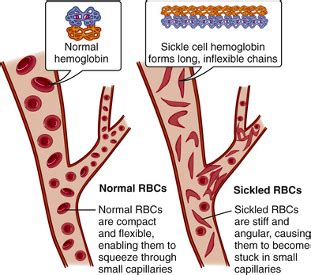 Sickle Cell Disease Flashcards Quizlet