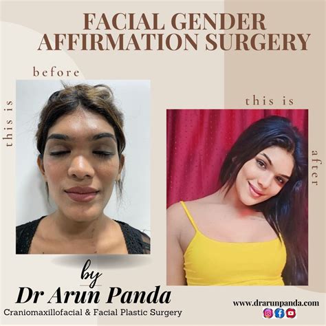 FACIAL GENDER AFFIRMATION SURGERY IN INDIA