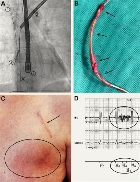 Transvenous Lead Extraction Tle Technique And Indications Panel A